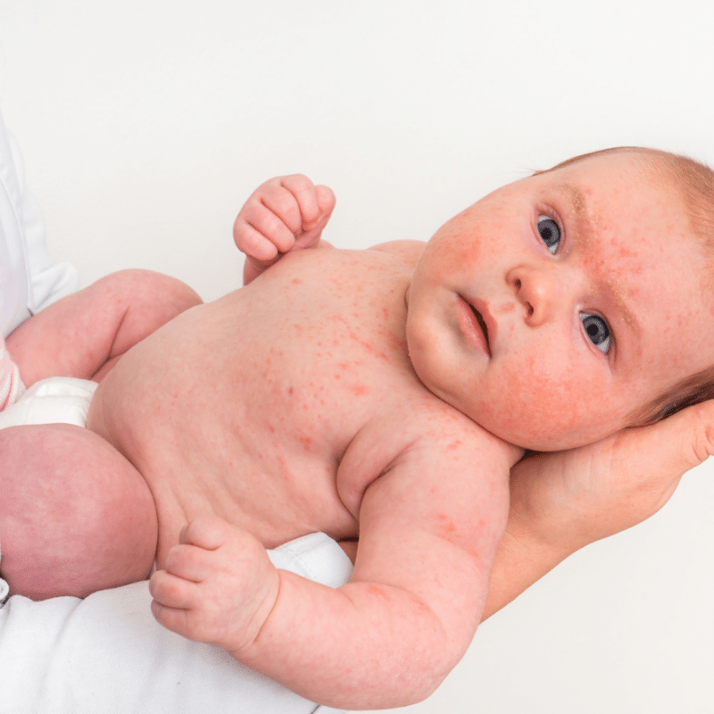 Newborn Eczema